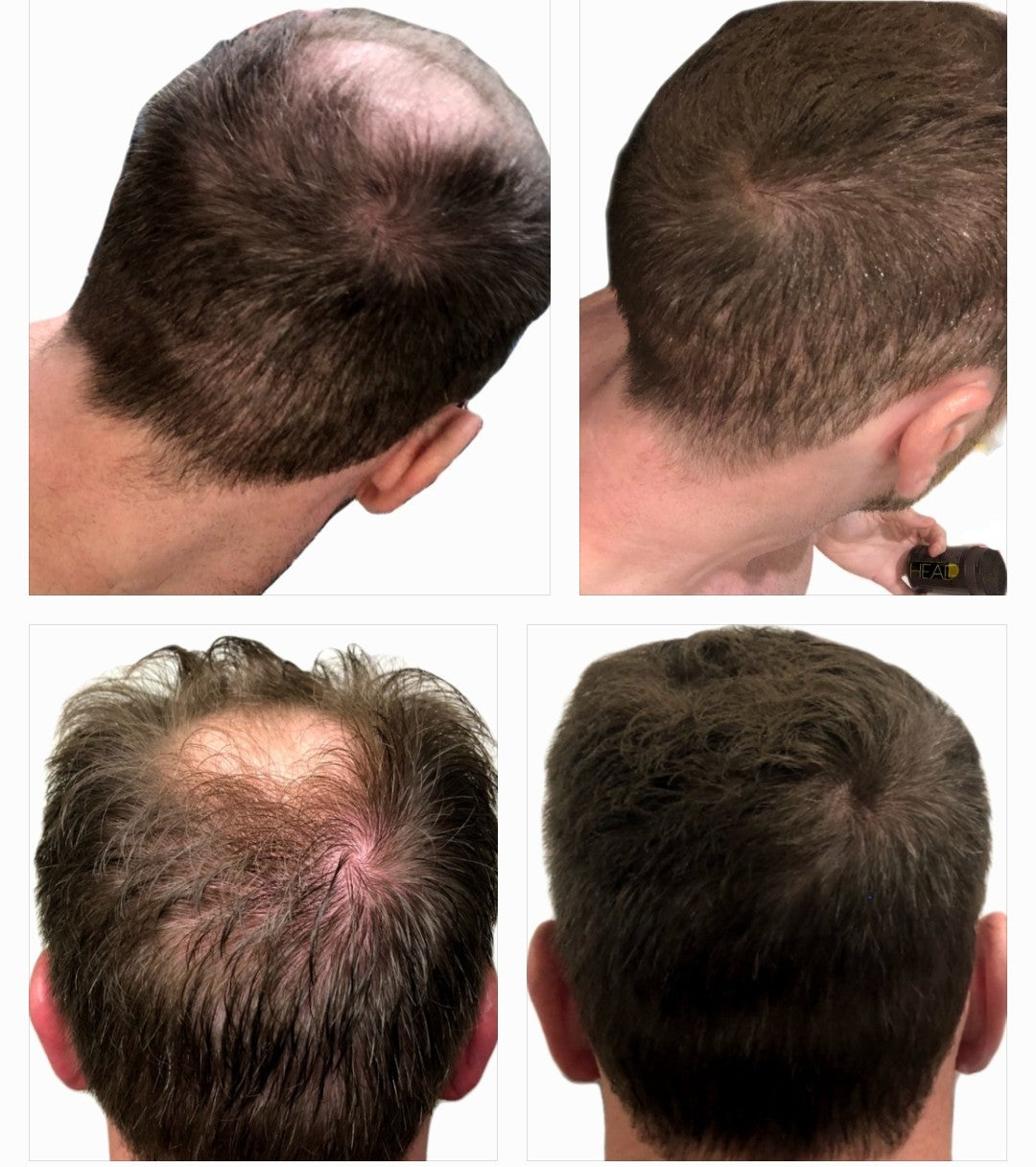 Before-and-after photos illustrating application of the product and the transformative effect of Headd hair fibers, showcasing a fuller and thicker hair appearance. Additionally, an illustration depicts hair thinning or balding with a close-up view of a scalp, emphasizing reduced hair density and visible skin.